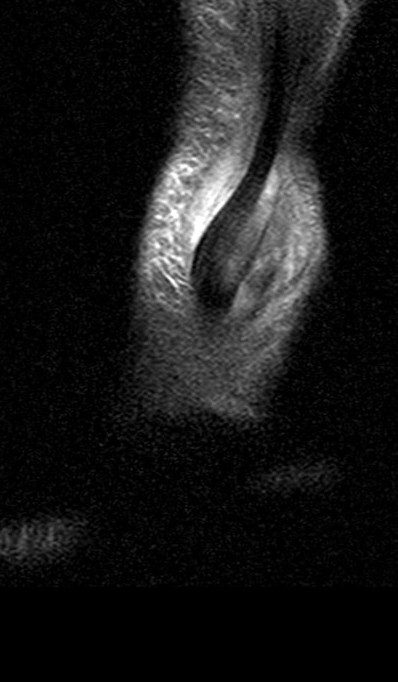 Figure 4 for case peroneal dislocation